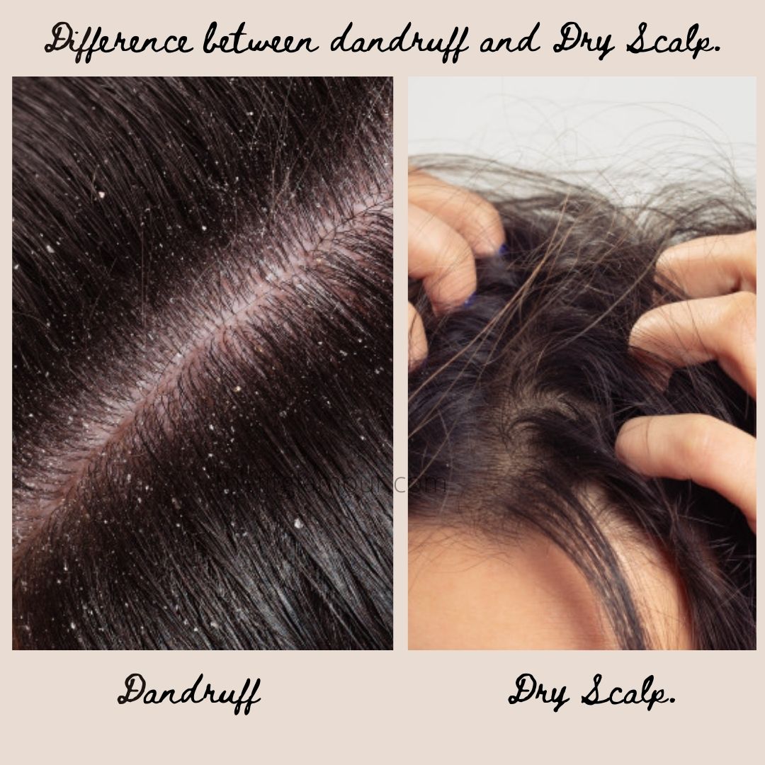 Difference between Dandruff and Dry Scalp