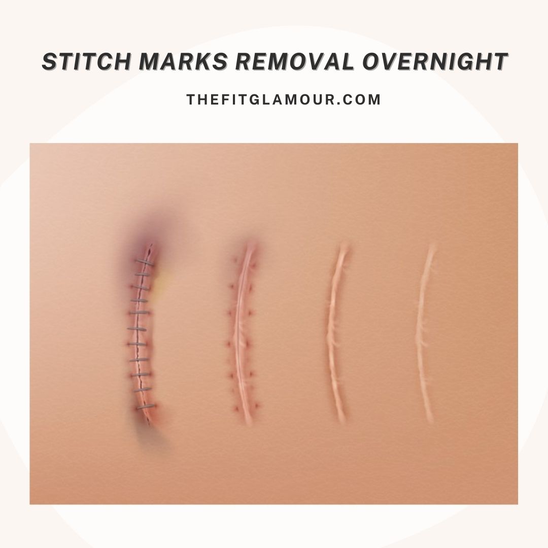 stitch marks removal overnight