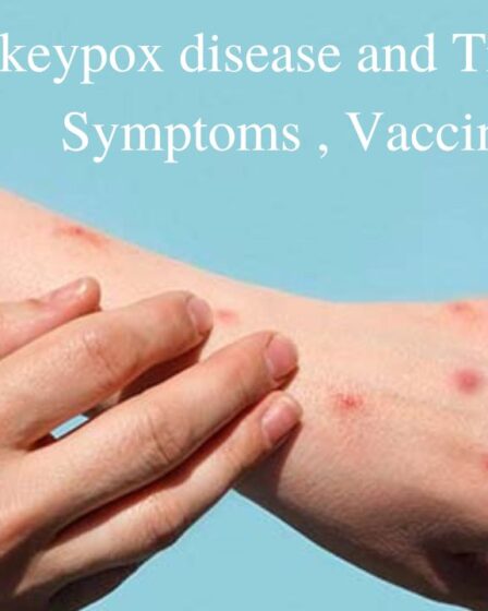 Monkeypox disease