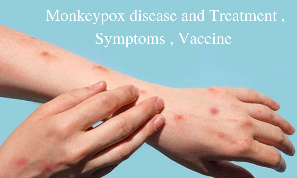 Monkeypox disease